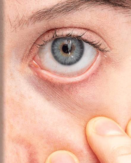 Pterygium, Pterygium Surgery